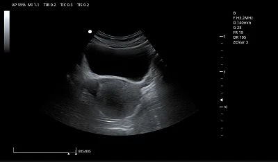 Bladder & Uterus(001)